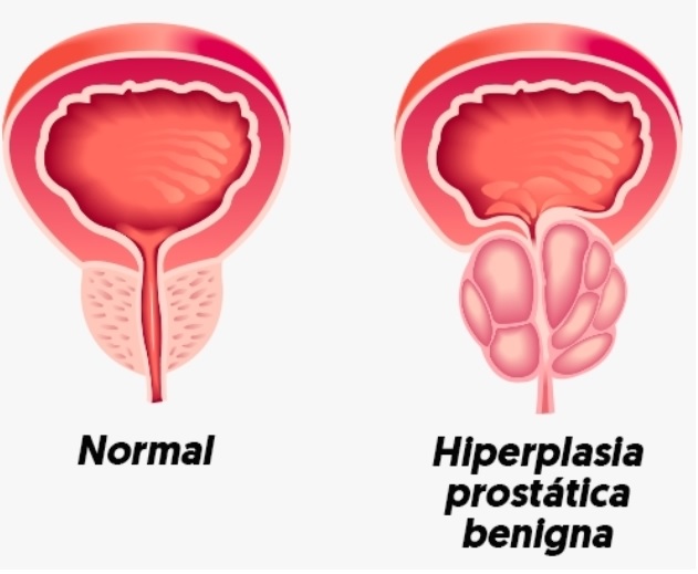 Hiperplasia-Prostática-Benigna-imagem-ilustrativa