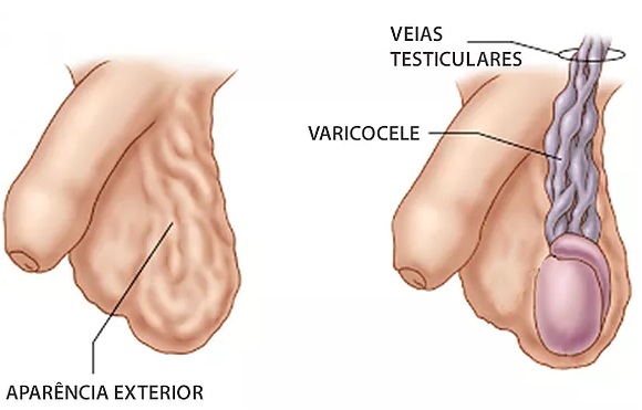 Alerta: varicocele é a principal causa de infertilidade masculina